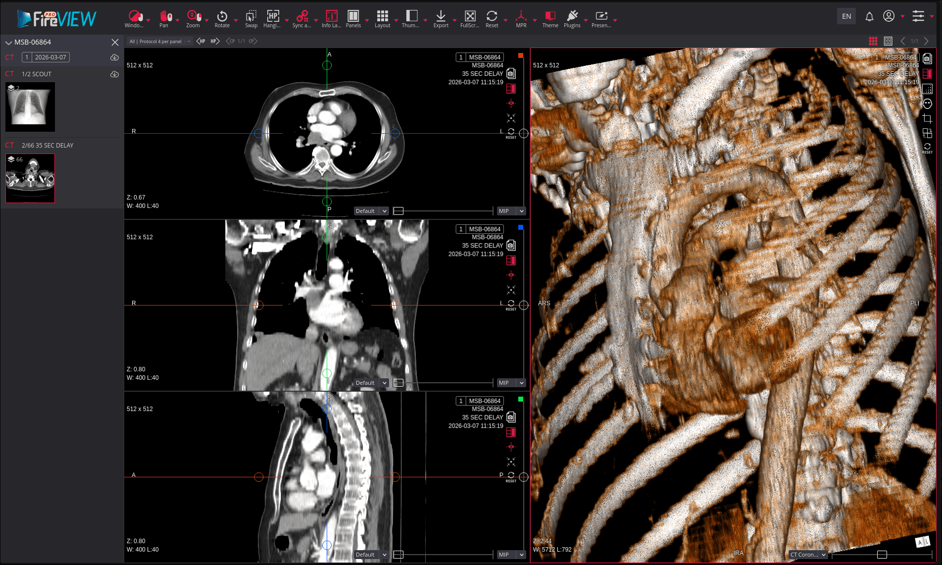 Visualisation 3D d'une imagerie médicale dans le viewer FireView